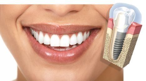 Implantes dentales, reemplazar dientes perdidos 16