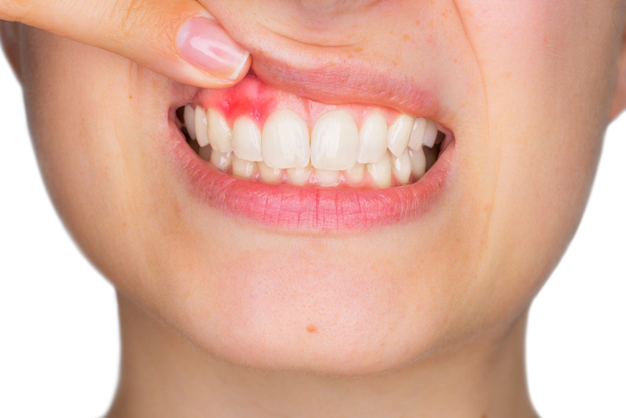 Gingivitis y sensibilidad dental: causas y tratamiento de las enfermedades dentales más usuales 25